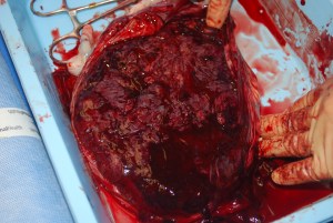 maternal side of placenta