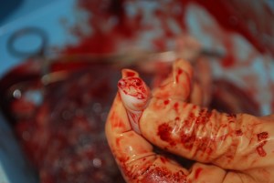 Umbilical cord